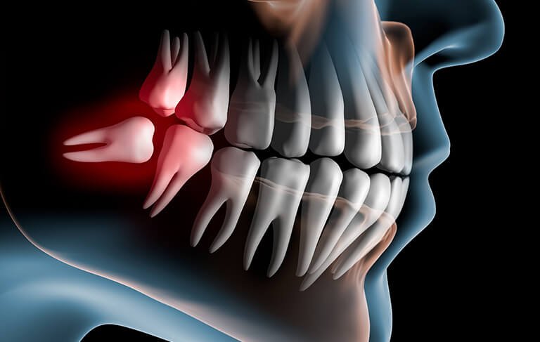 wisdom tooth removal