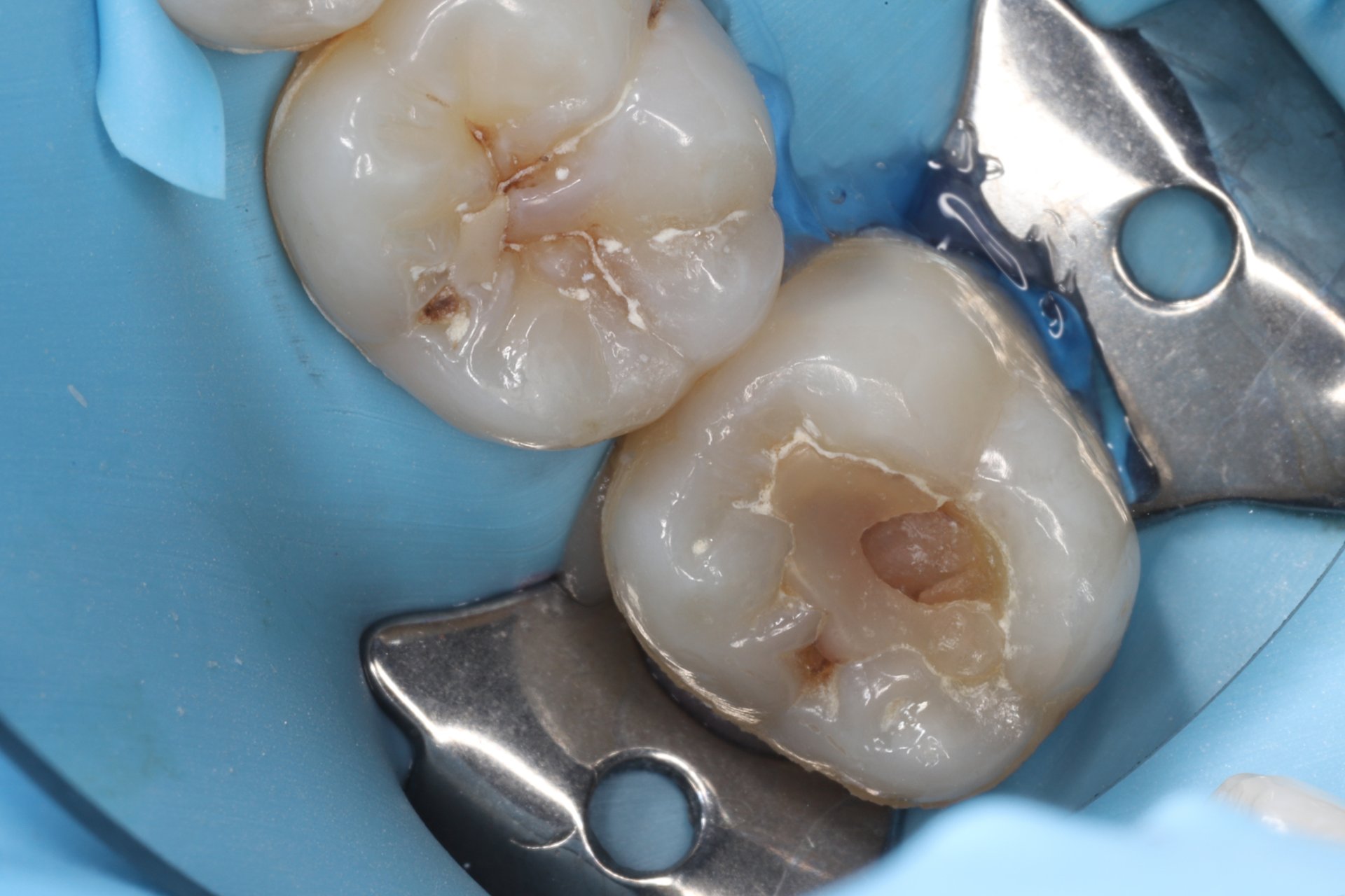 aesthetic tooth filling before