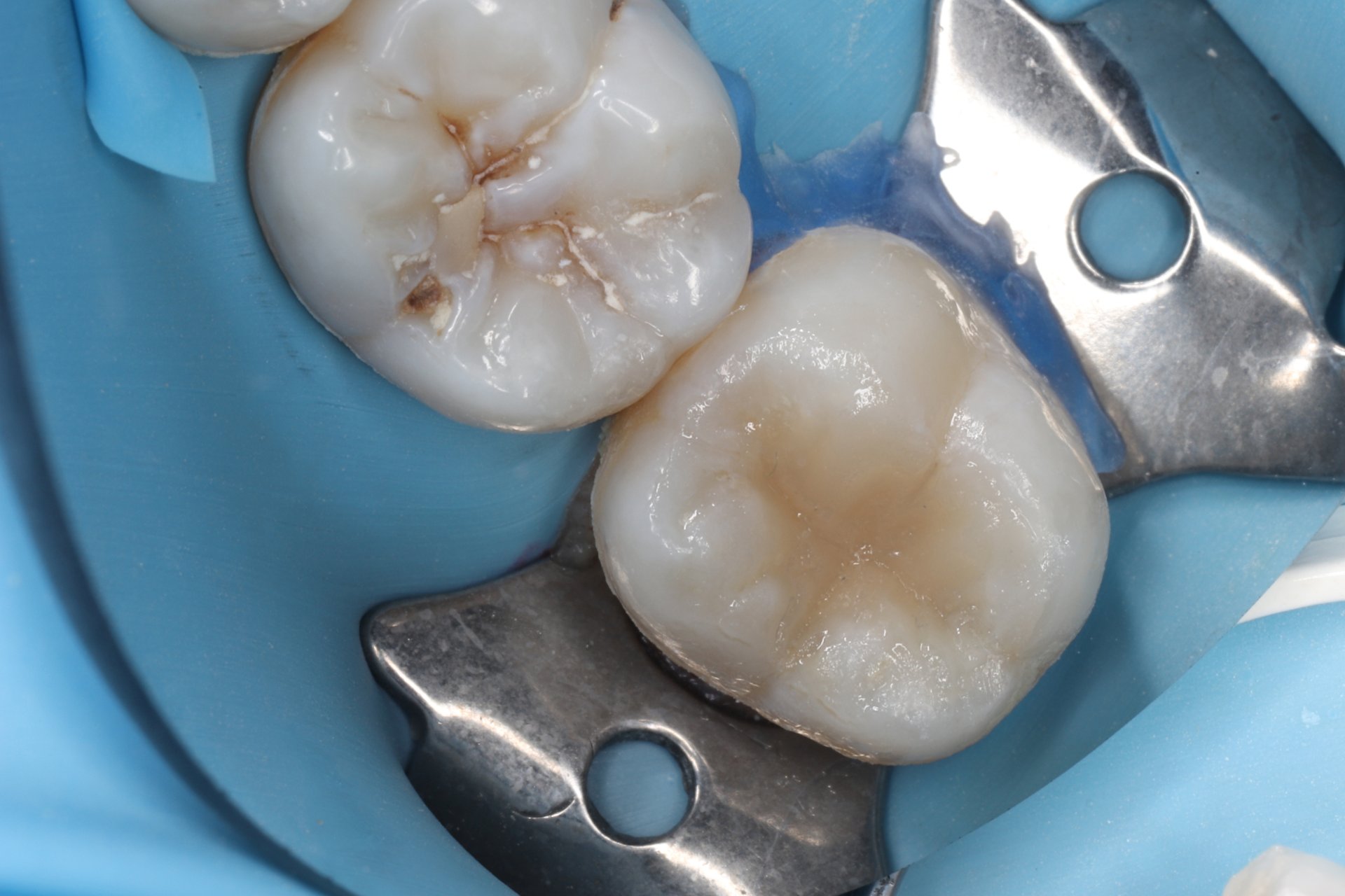 aesthetic tooth filling after