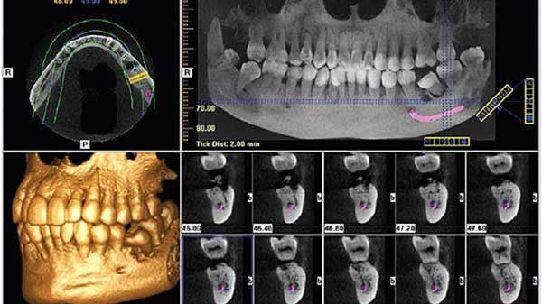 Fogászat CT Fogászati CT felvétel