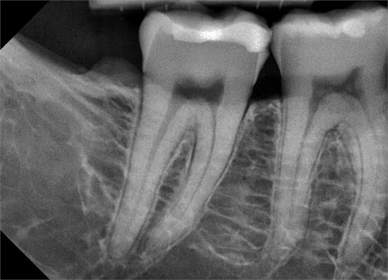 Digitális intra röngten fogászat Digitális röngten