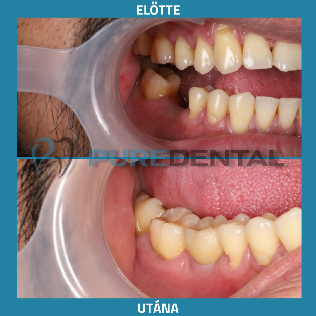 Fogkorona árak eredmény