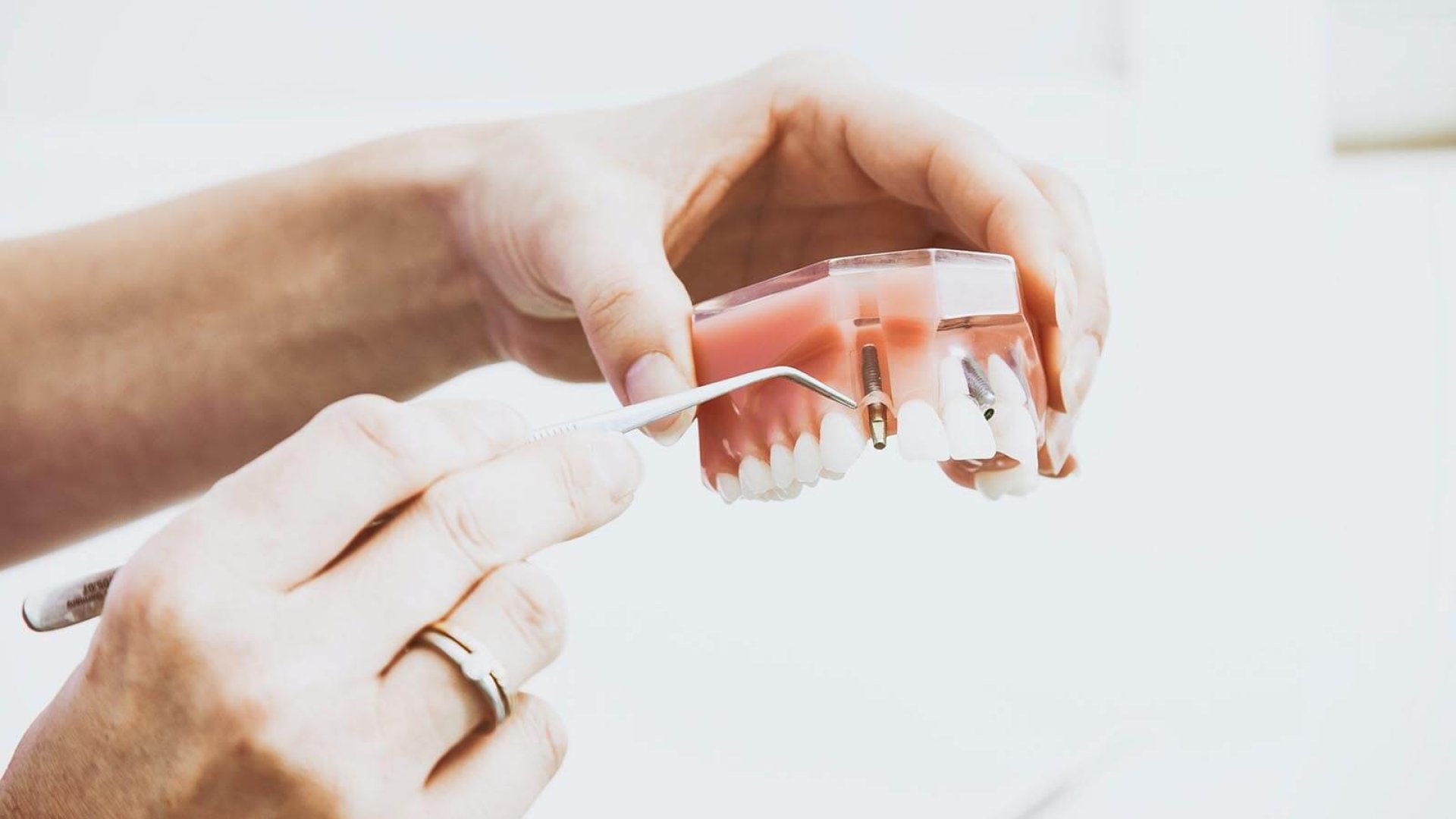 Zahnimplantate | PureDental Zahnimplantate Ungarn | PureDental