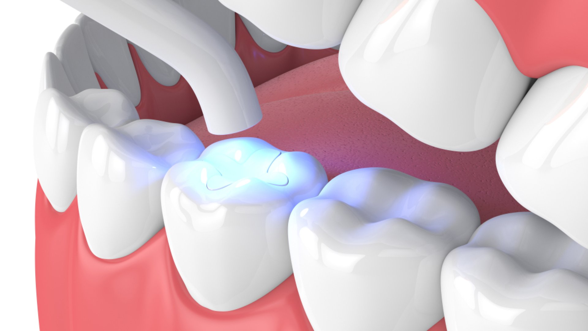 Esztétikus fogtömés Budapesten