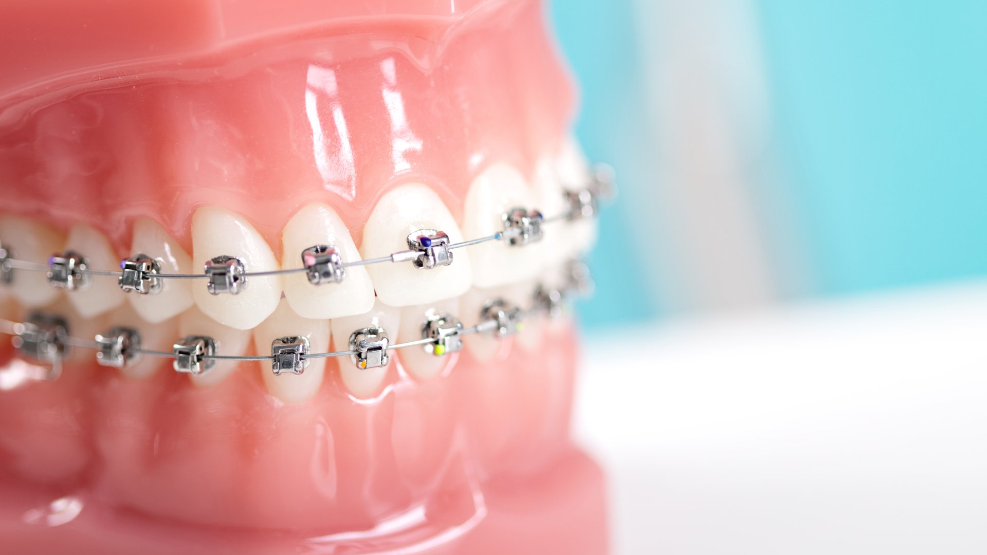 Fogszabályzás Budapesten a szabályos fogakért | PureDental