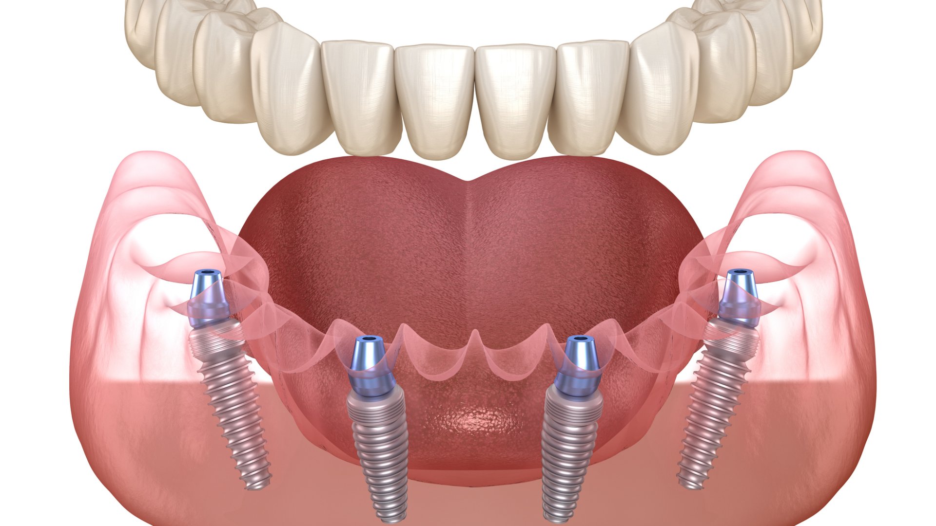 All on 4 fogpótlás 