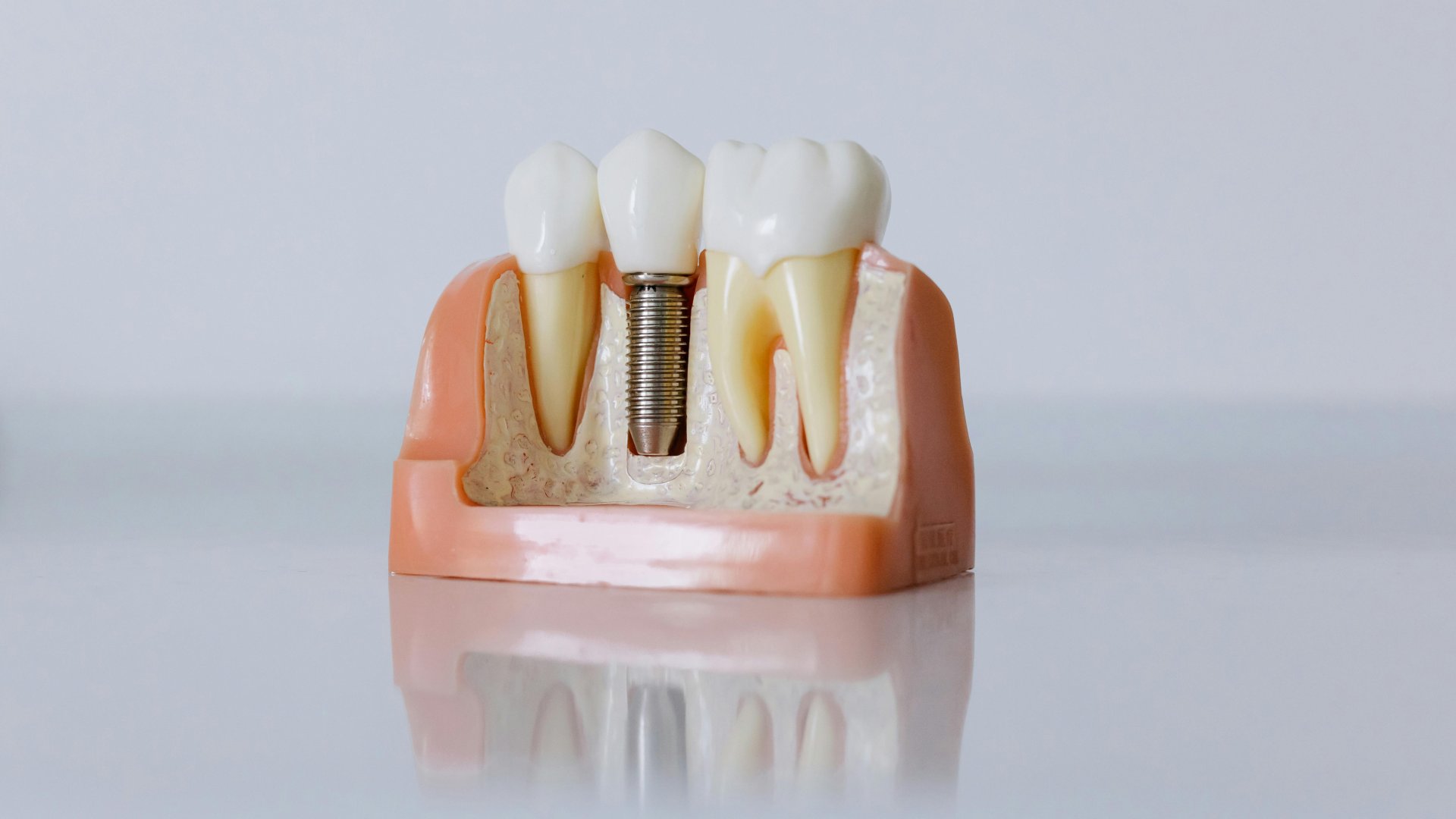 Why Dental Implants Are the Best Solution for Missing Teeth Why Dental Implants Are the Best Solution for Missing Teeth