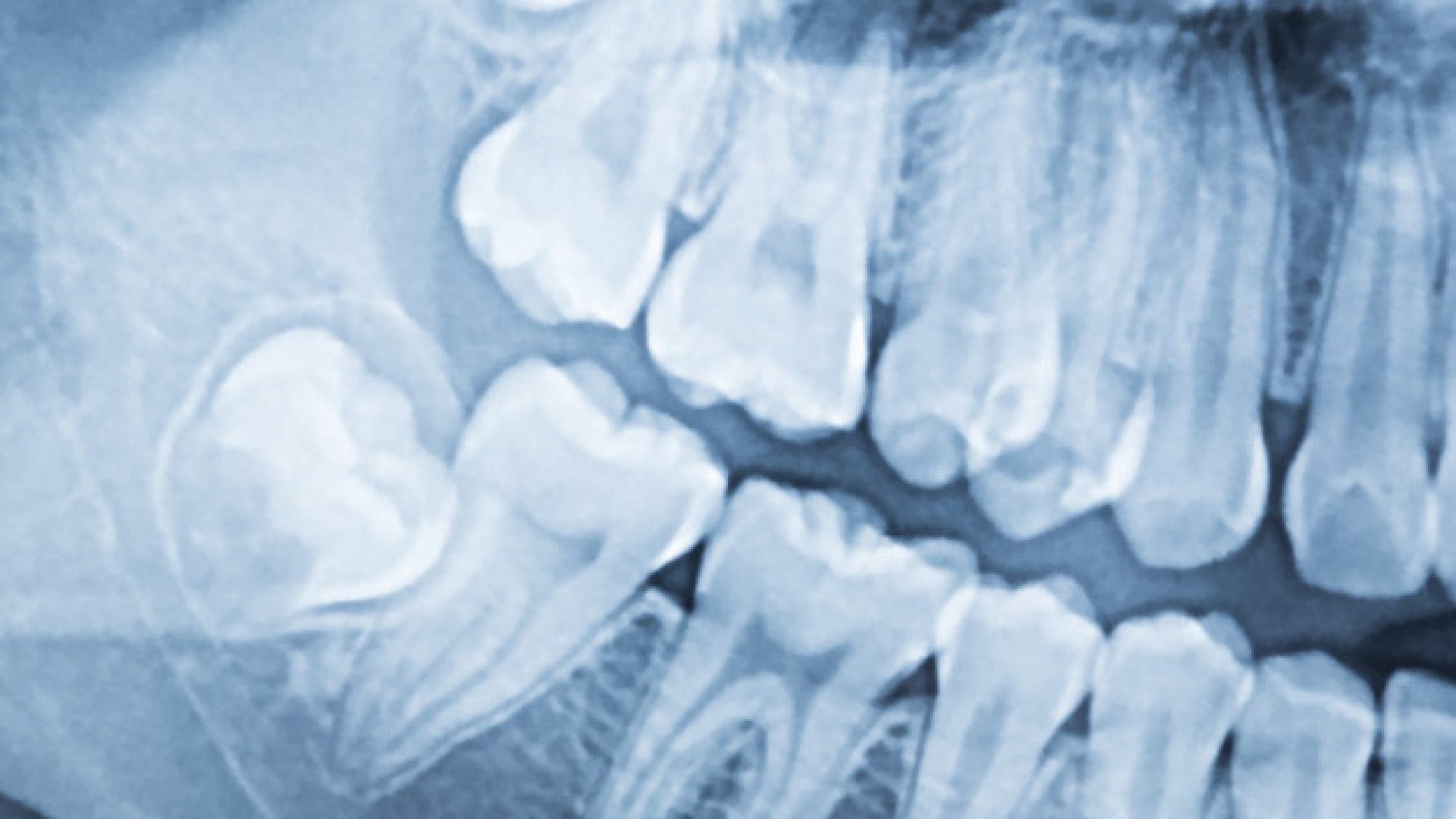 Dental implant placement at PureDental Dentistry Dental implant placement at PureDental Dentistry