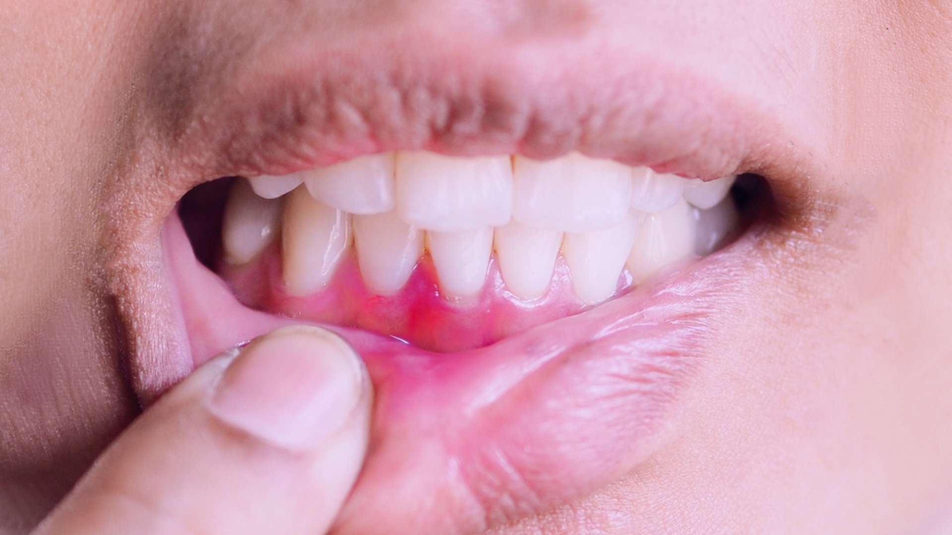 How do we treat periodontal disease? | PureDental How do we treat periodontal disease? | PureDental