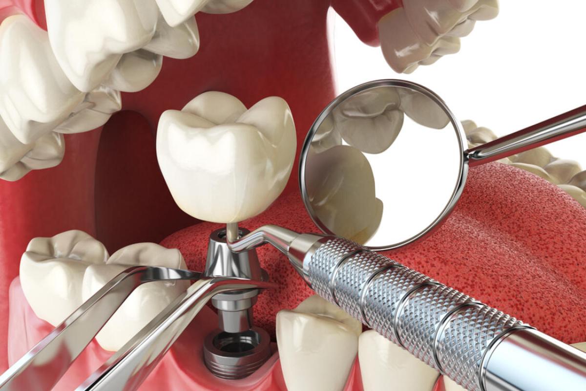 5 tudnivaló a fogimplantátumokról