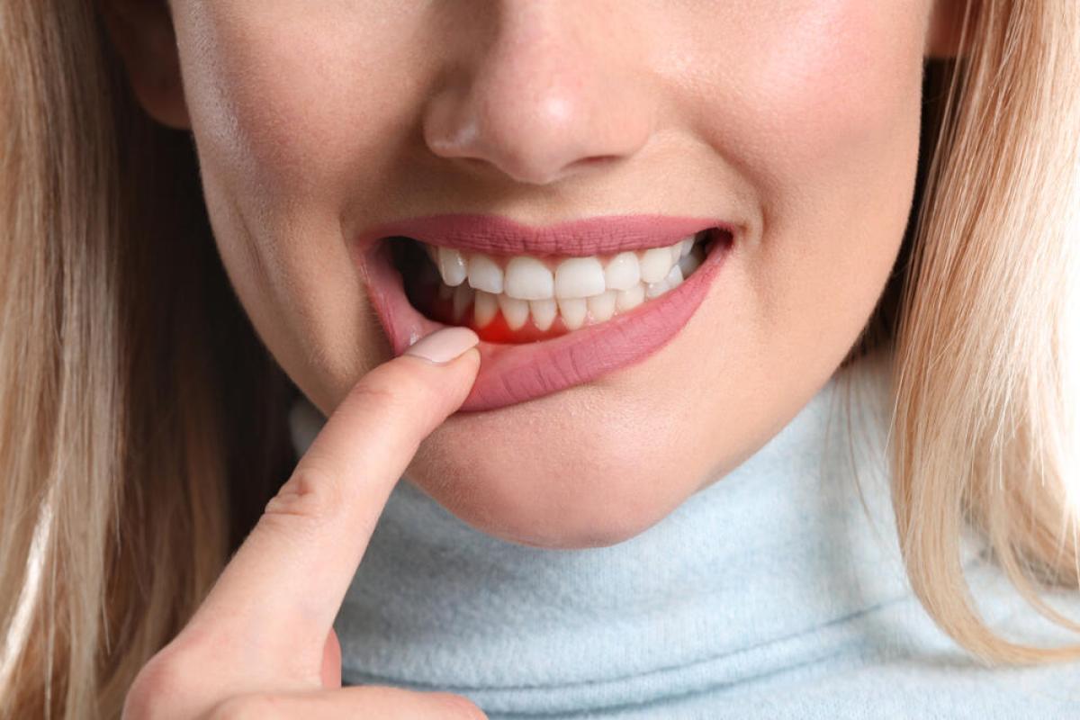 A fogágybetegség kialakulásának okai: mi okozza a fogágybetegséget, hogyan lehet elkerülni?