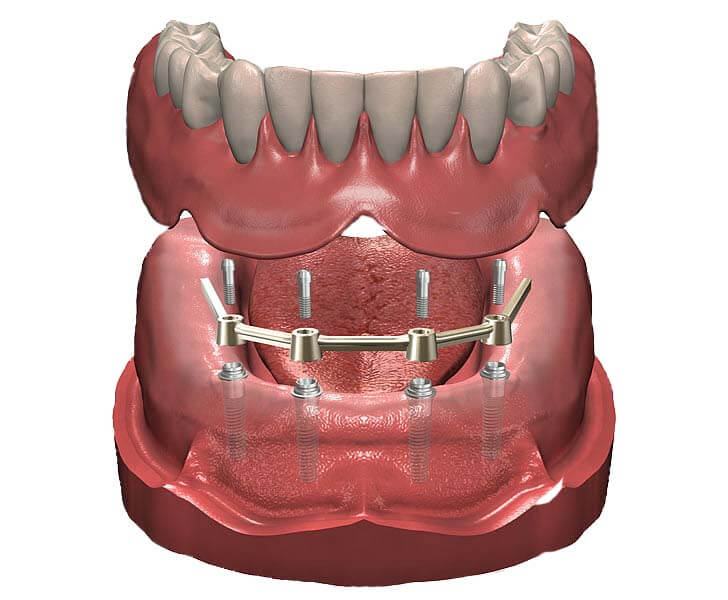 Stéges fogsor implantátumokhoz