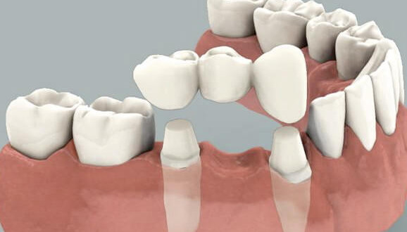 temporary dentures