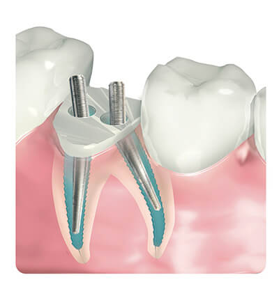 root canal treatment in Hungary