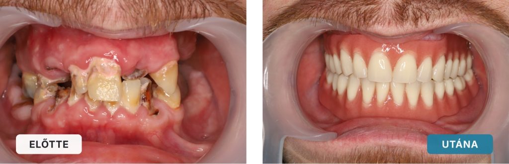 Jean Paul Stéges Fogsor Implantátumokra Rögzítve Eredménye Esettanulmány - Dr. Boka Nóra