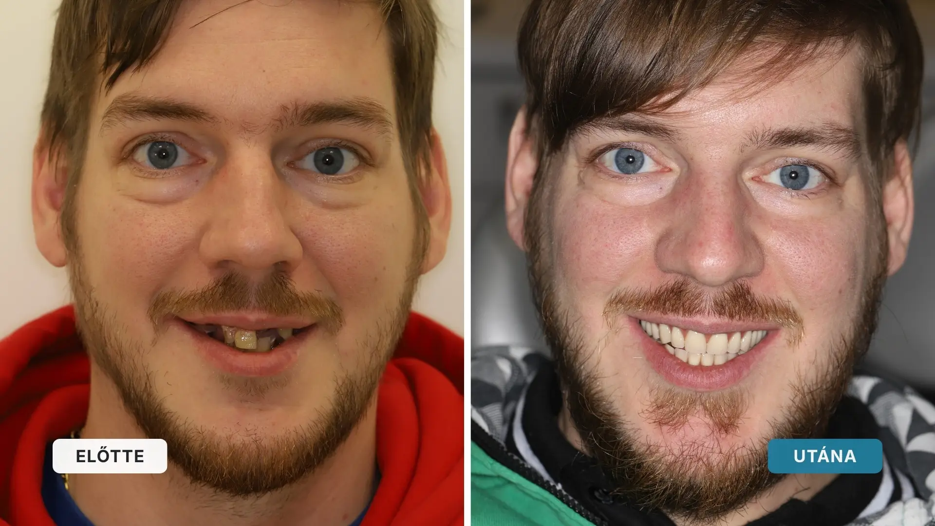 Before and after results of our bar-retained denture patient