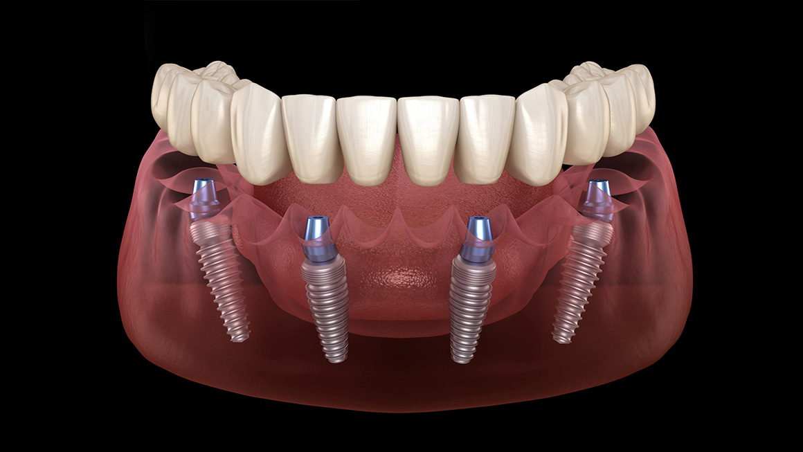 All-on-4 dental prosthesis