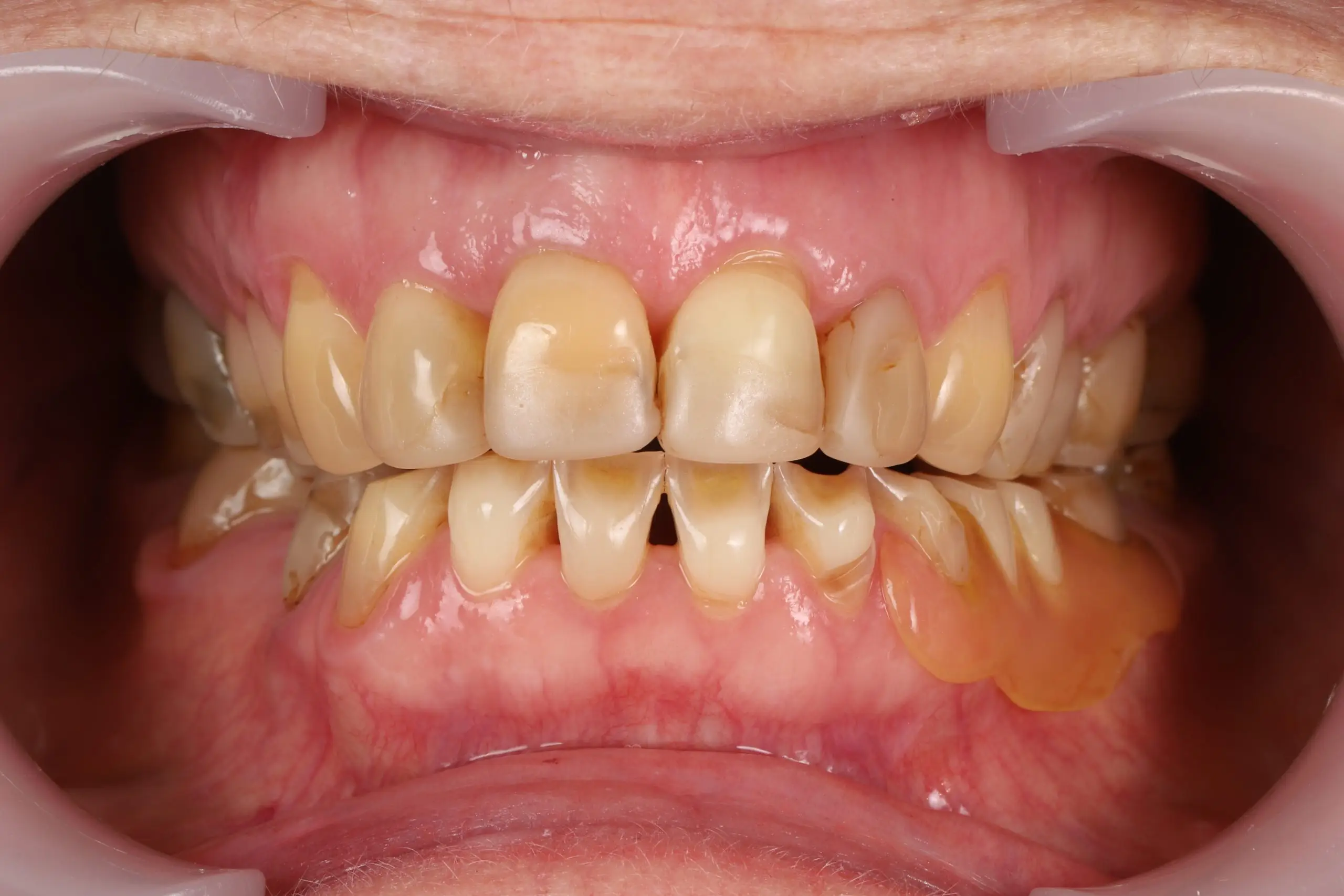 Before – discoloured, uneven teeth