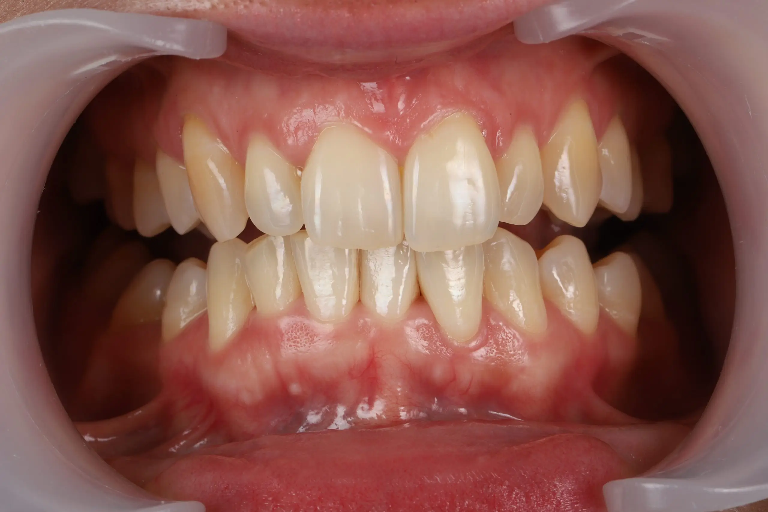Before – discoloured teeth