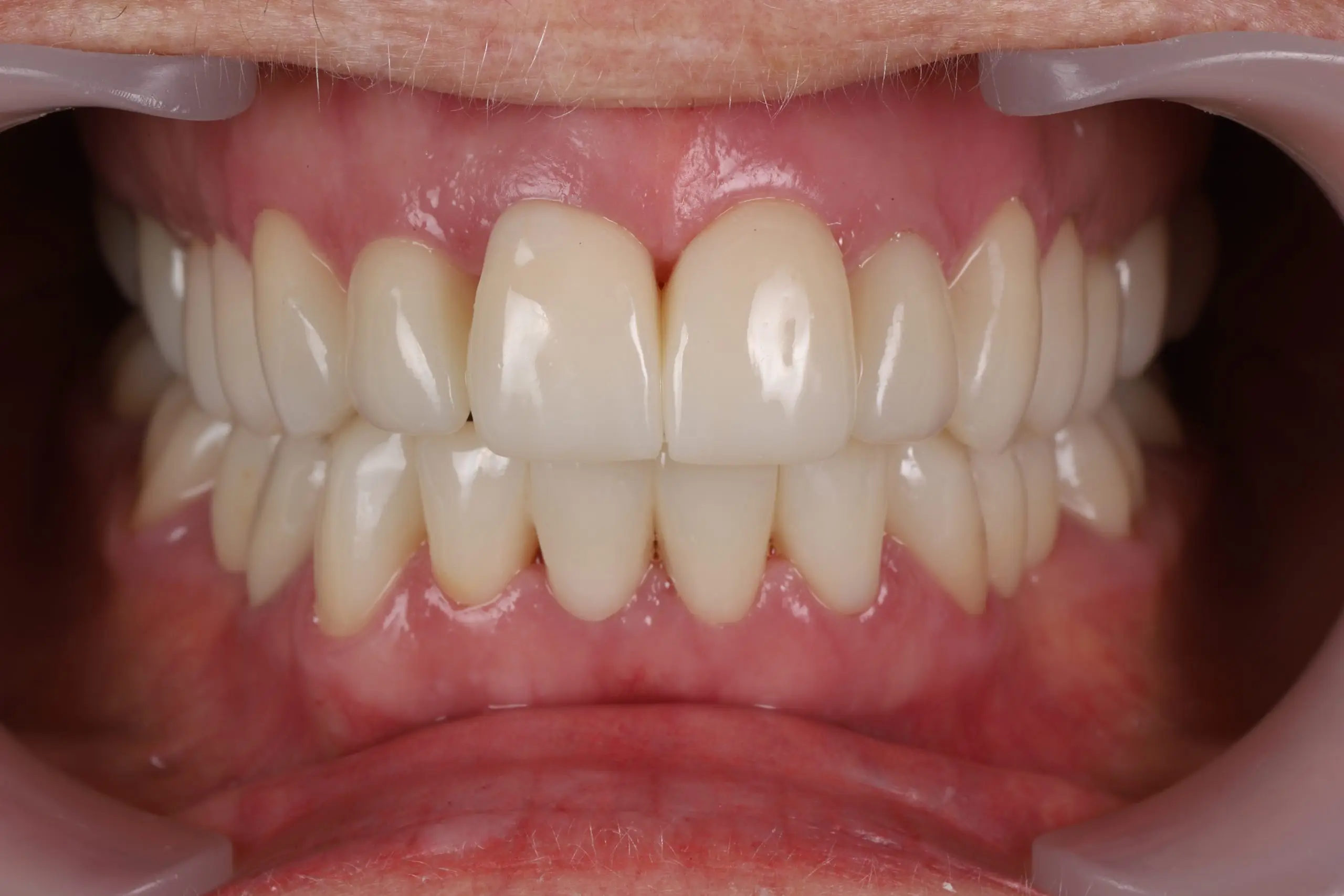 After – restored upper and lower arches with zirconia crowns