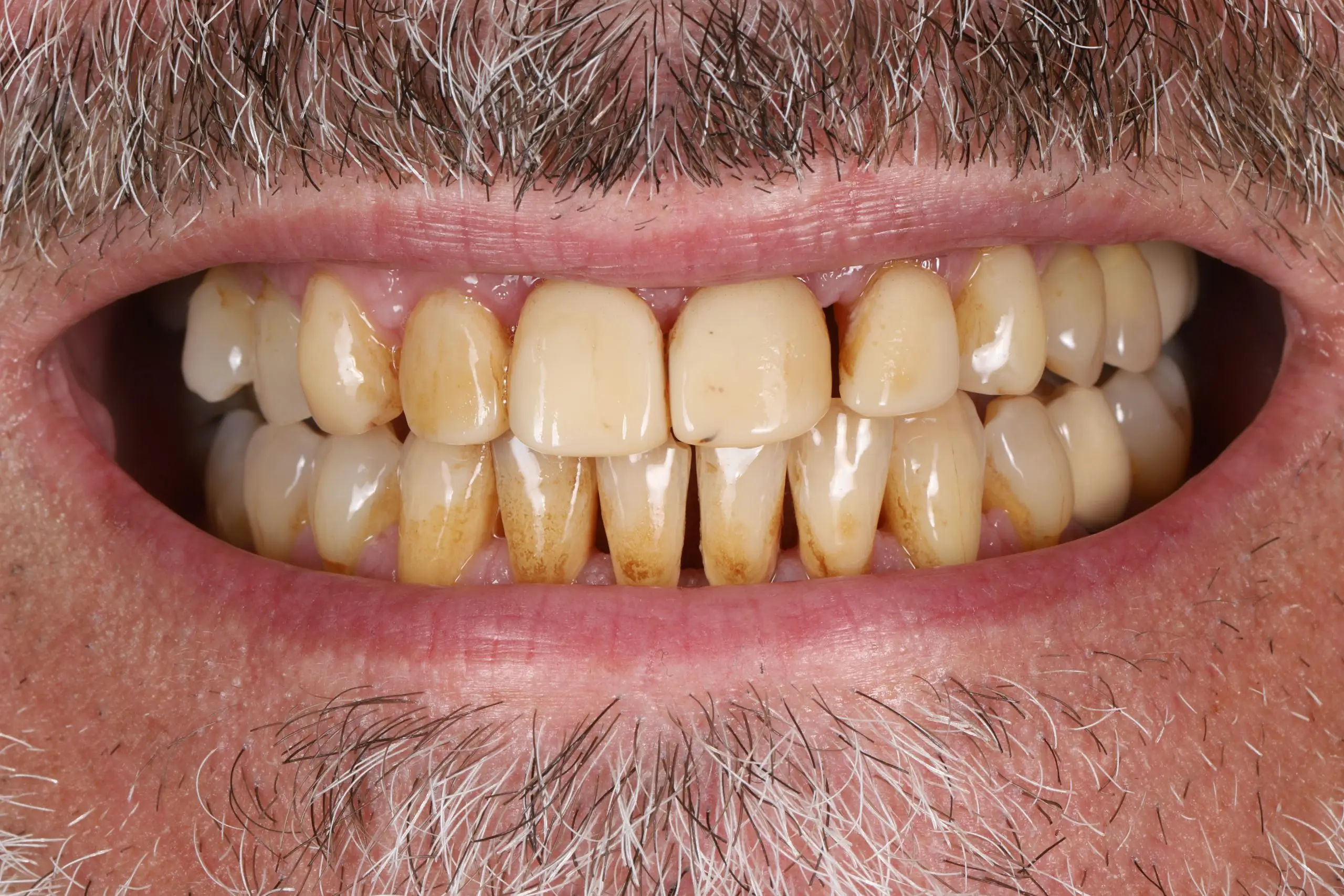 Before – worn, discoloured front teeth