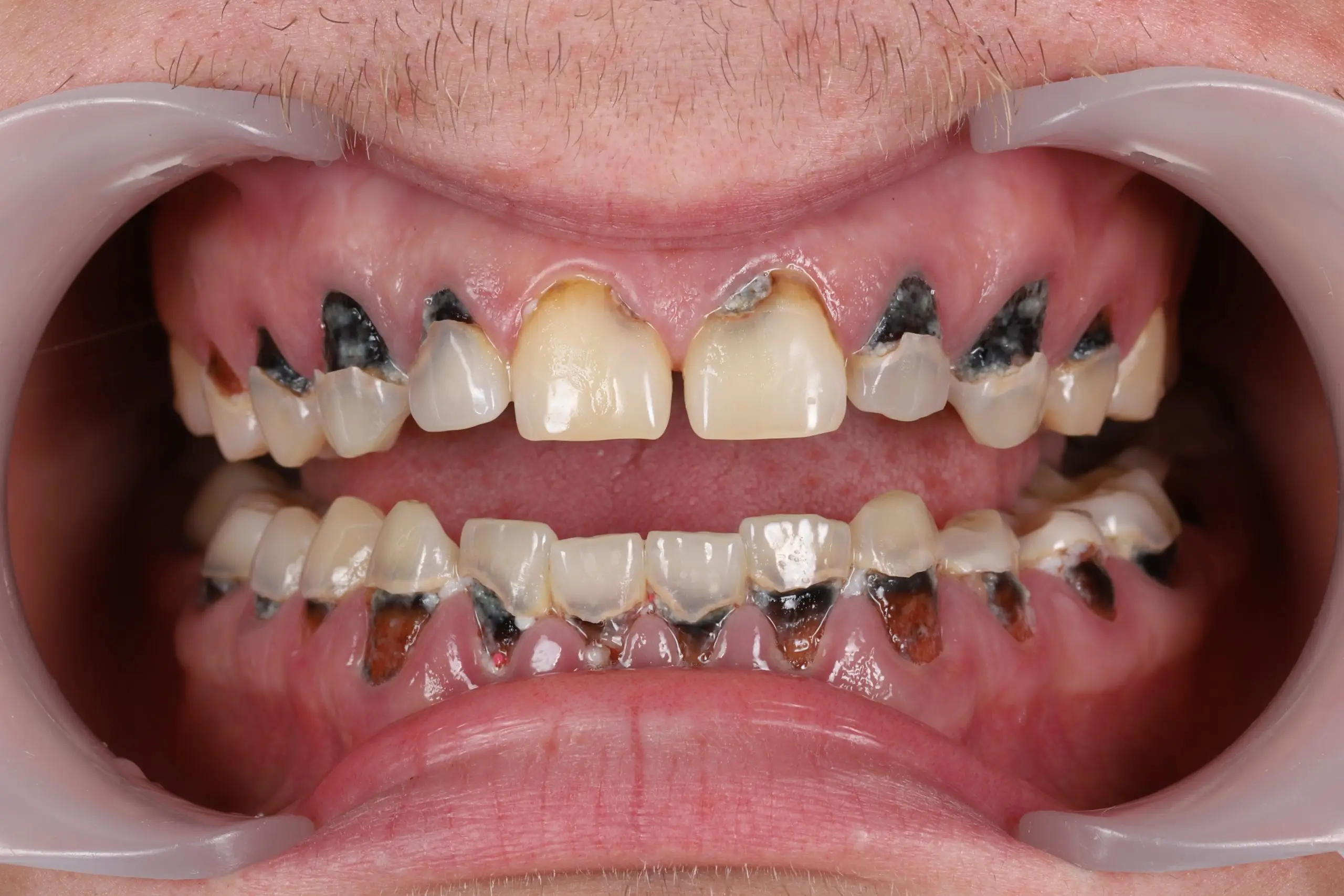 Before – decayed, neglected teeth