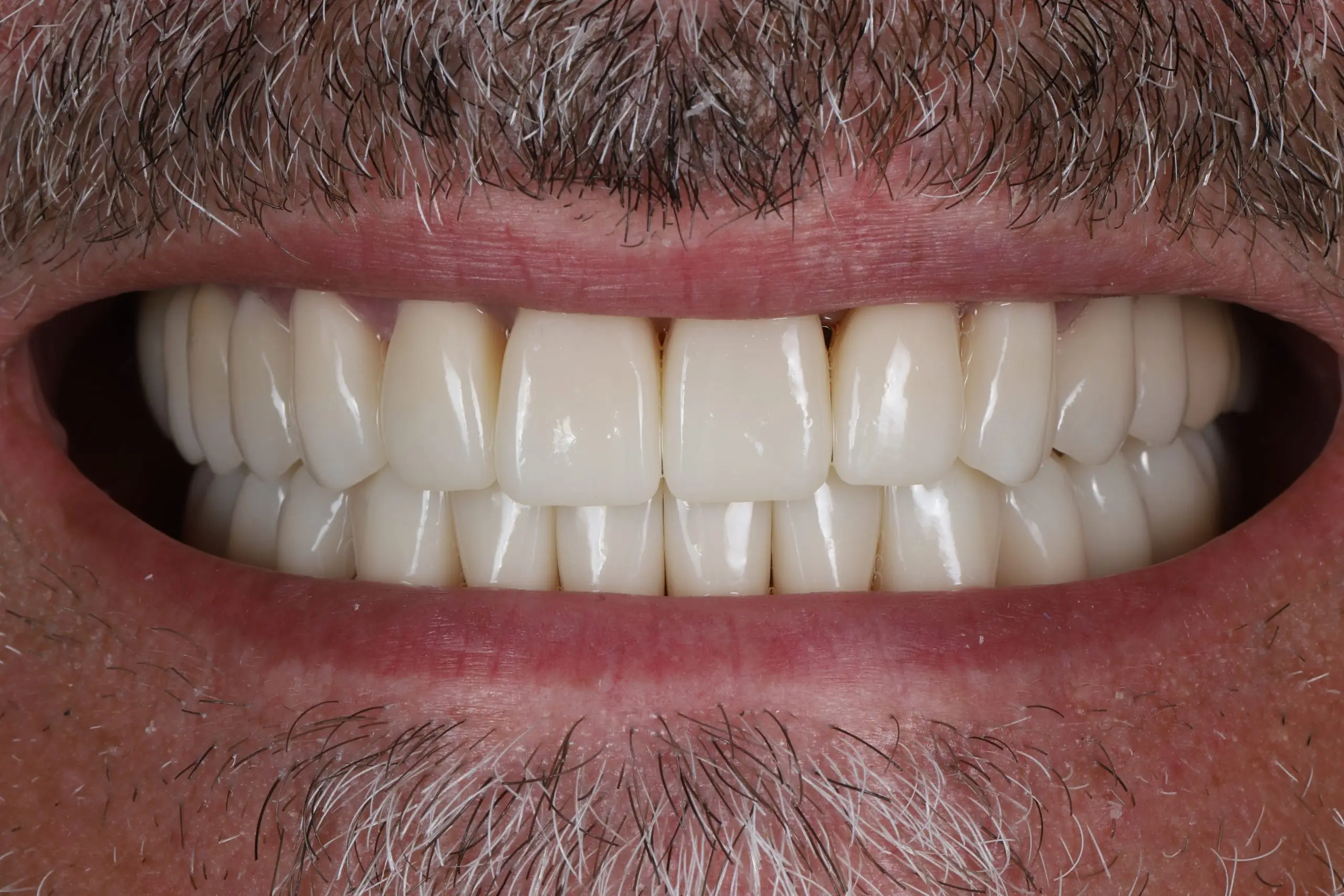 After – aesthetic smile with zirconia crowns