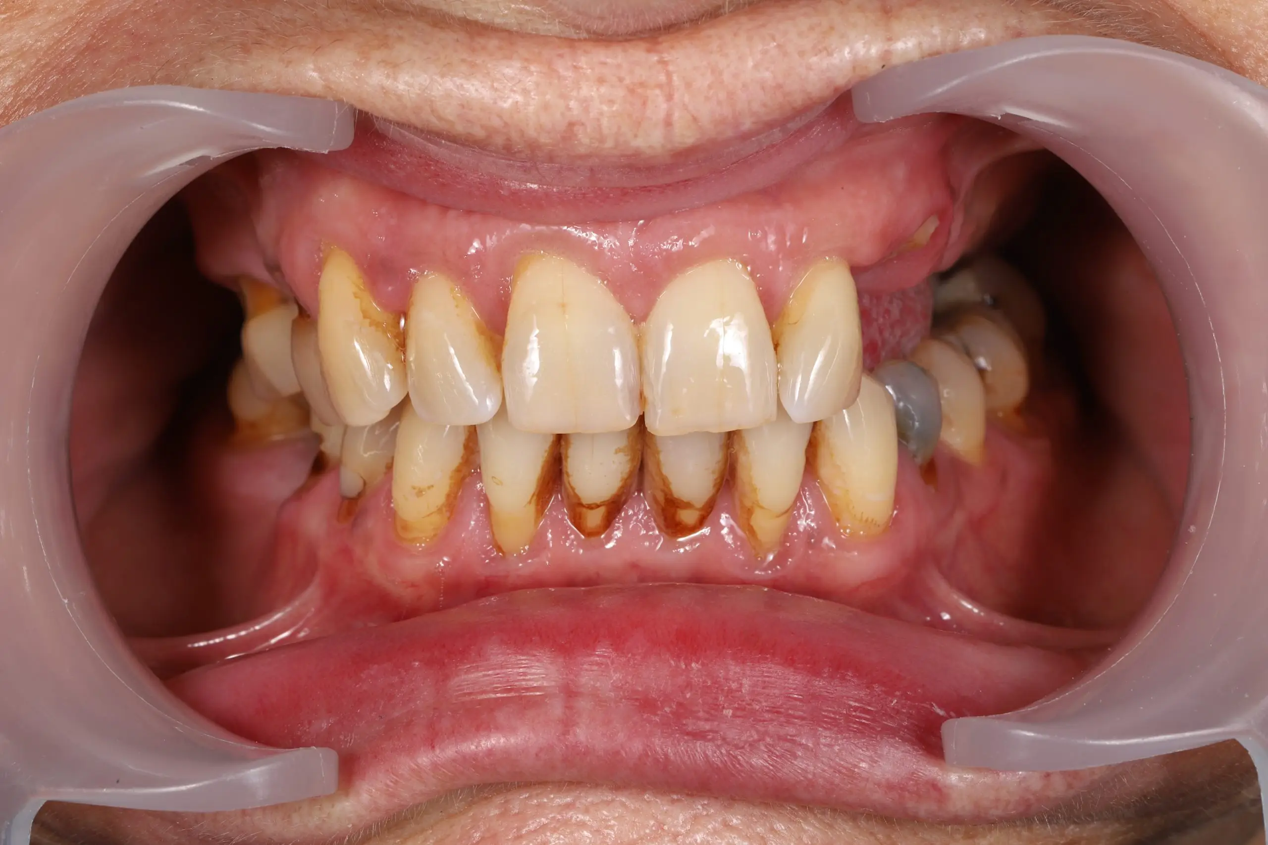 Before – worn, neglected dentition
